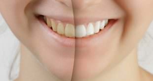 Gelbe Zähne - so werden sie wieder weiss